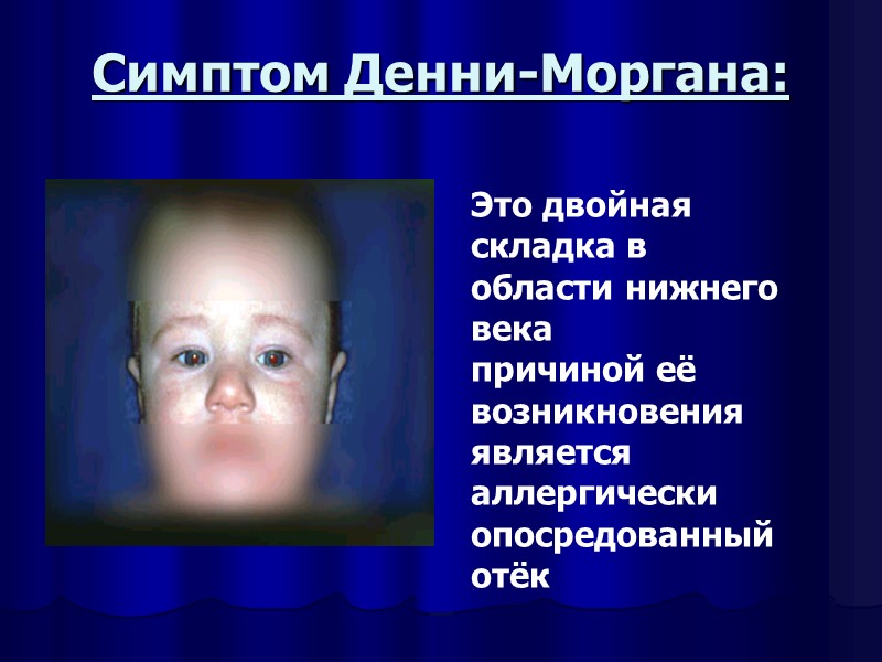 Симптом Денни-Моргана: Это двойная складка в области нижнего века причиной её возникновения является аллергически